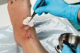 Professional wound care services at home in Nairobi